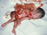 24 Week Abortion Image