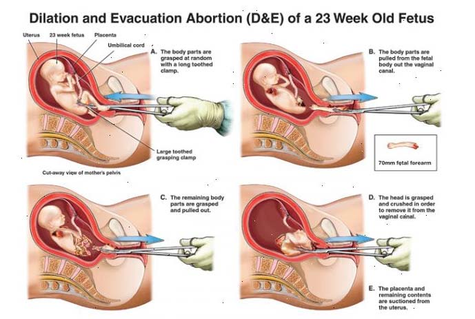 Abortion Horrors