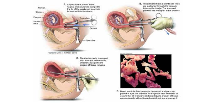 Abortion Horrors