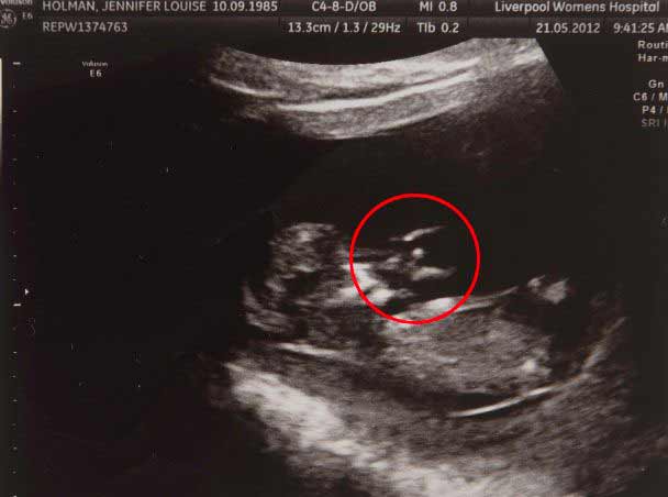 After Two Miscarriages, Angel in Ultrasound Convinced Mom This Threatened Baby Would Make It